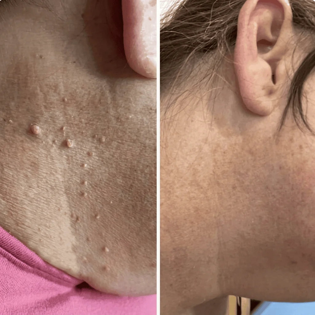 Krushop™ Dermly Advanced Skin Tag Care Set